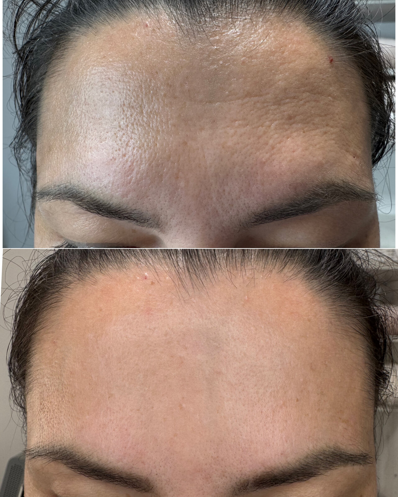 До/після Neocollagen Laser — розгладження зморшок лоба