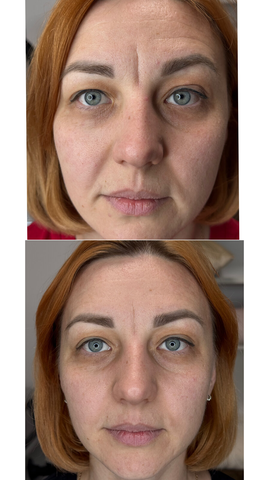До/після Neocollagen Laser — зменшення глибини зморшок