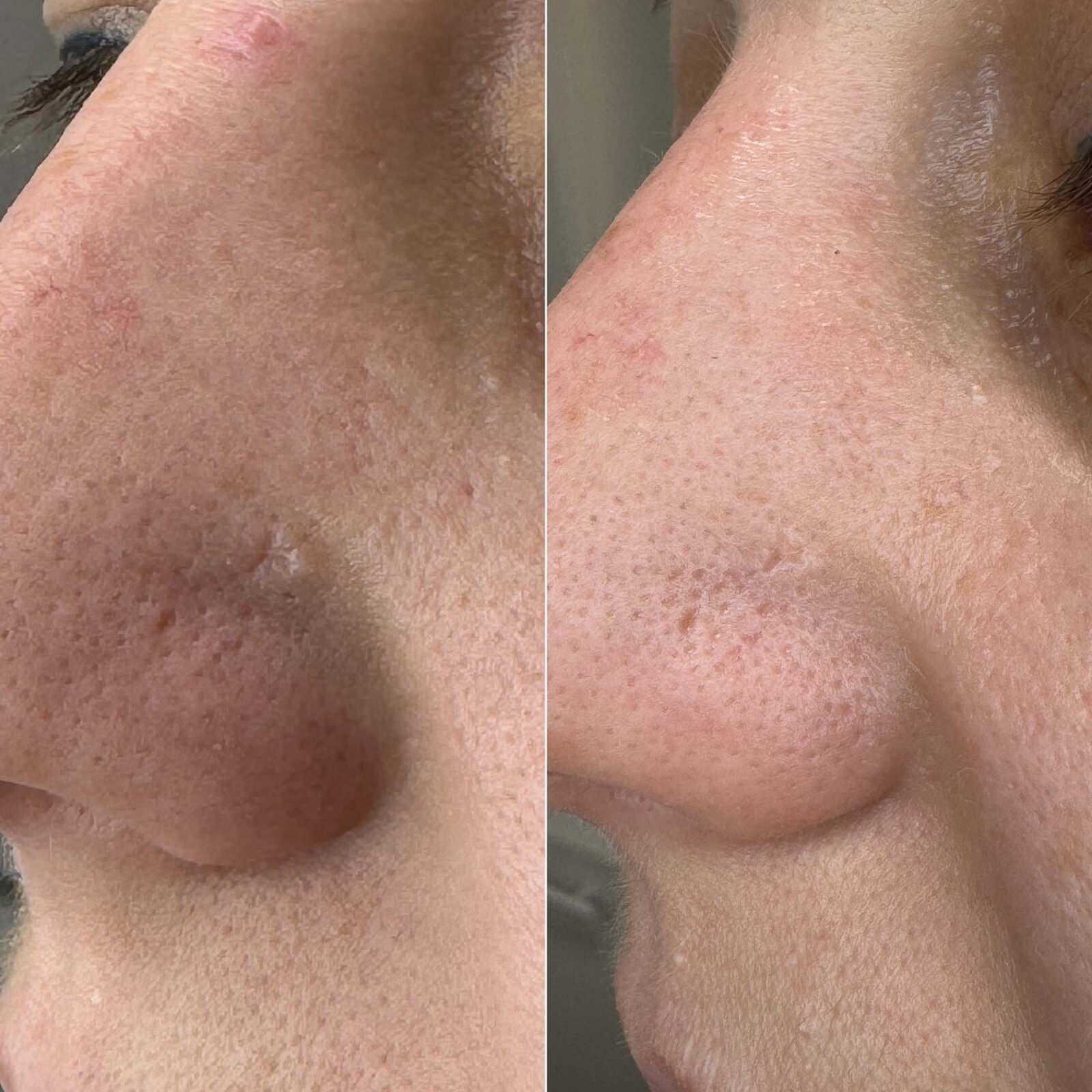 До/після Neocollagen Laser — звуження пор та покращення стану рубців