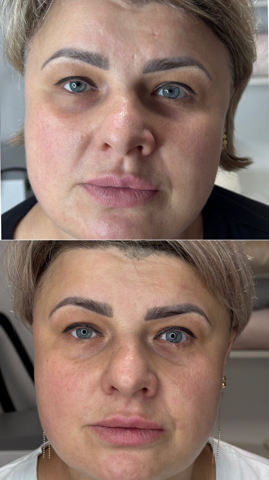 До/після Neocollagen Laser — легкий ліфтинг контуру обличчя