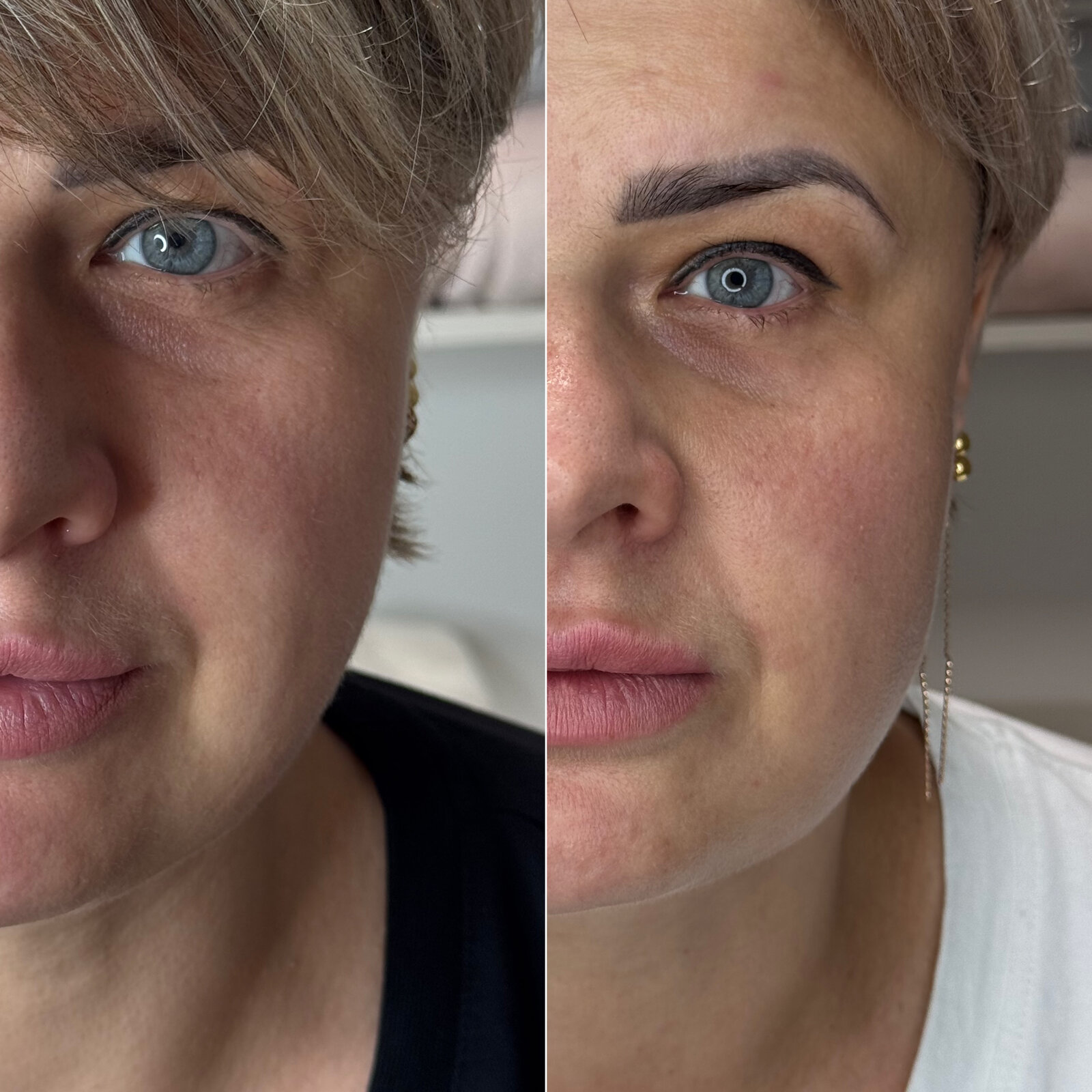 До/після Neocollagen Laser — покращення тону обличчя