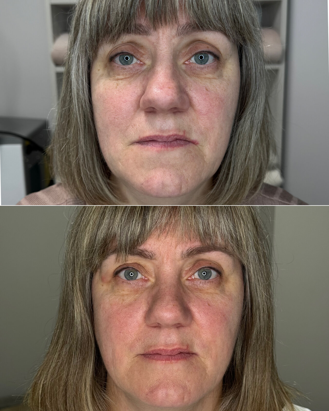 До/після Neocollagen Laser — зменшення глибини зморшок