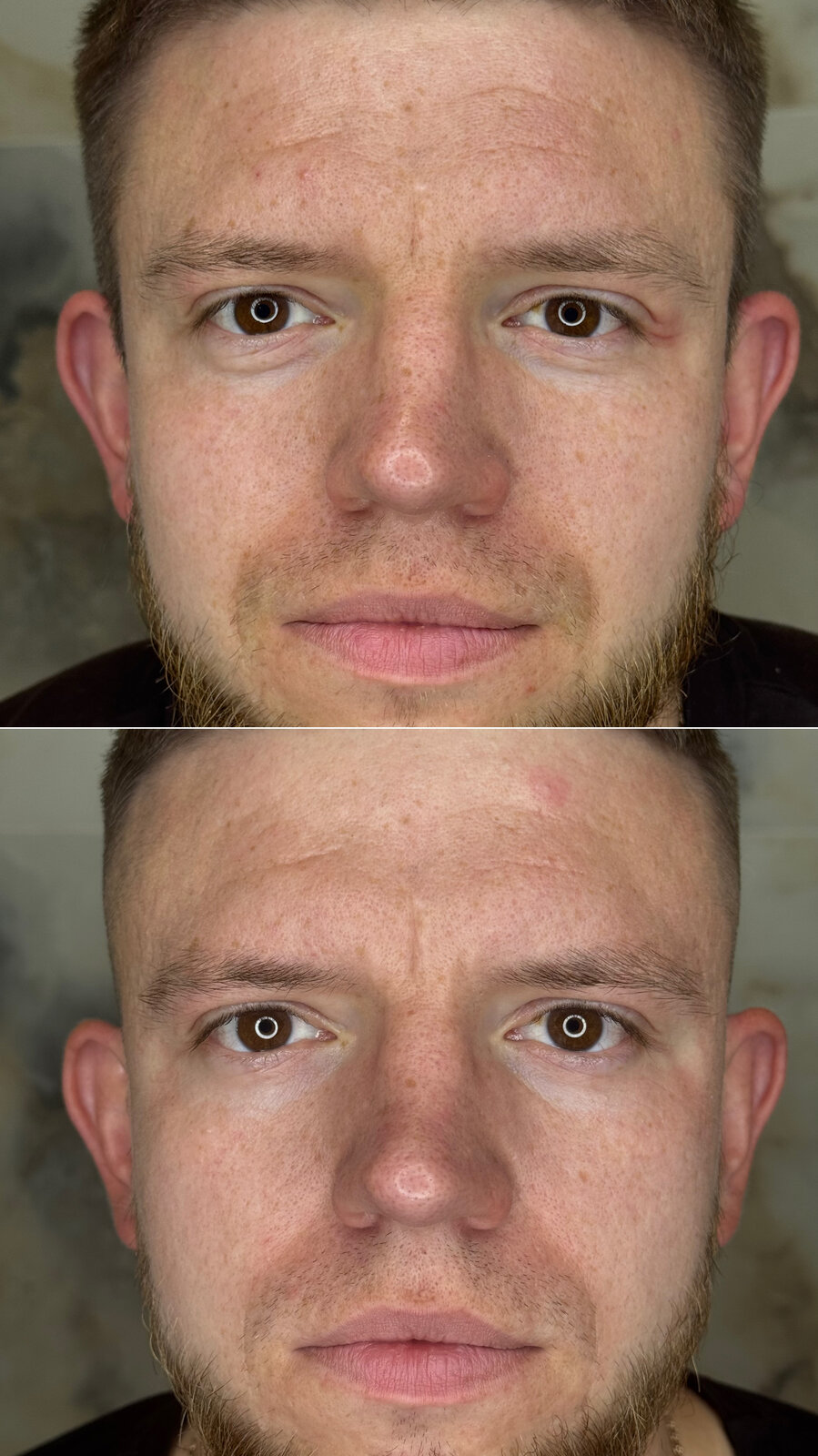 До/після Neocollagen Laser — результат для чоловічої шкіри